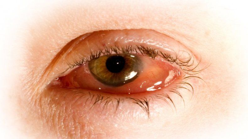 Conjuntivitis: Causas y prevención