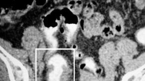 Mangos y plátanos verdes podrían ayudar a prevenir el cáncer de colon