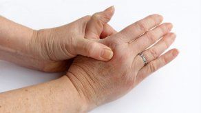 6 cosas que hay que saber acerca de la artritis reumatoide
