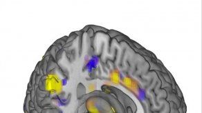 Logran medir el dolor cerebral con imágenes