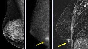 Desarrollan nueva cámara para exámenes de senos