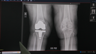 Hospital Santo Tomás inicia jornada gratuita de reemplazo de rodilla Hospital Santo Tomás inicia jornada gratuita de reemplazo de rodilla