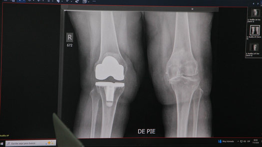 Hospital Santo Tomás inicia jornada gratuita de reemplazo de rodilla Hospital Santo Tomás inicia jornada gratuita de reemplazo de rodilla