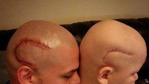 Un padre se tatúa la cicatriz de su hijo