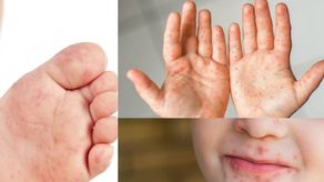 Síntomas del virus boca, manos y pies