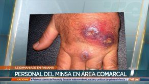 Aumentan los casos de leishmaniasis en Panamá