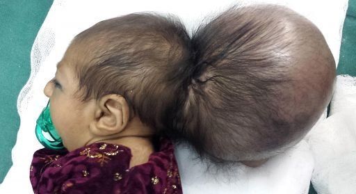 Médicos afganos retiran una segunda cabeza del cráneo de un bebé