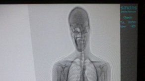 Descubren una llave para abrir esposas en el estómago de un preso uruguayo