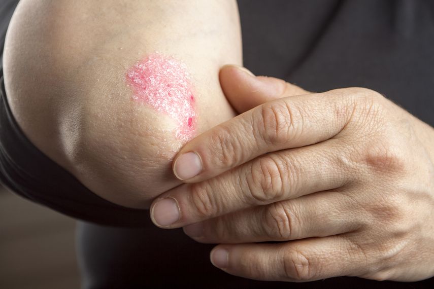 La ley establece el 29 de octubre de cada año Día de la Psoriasis.