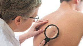 Estudio: Casados detectan melanomas antes que los solteros