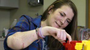 EEUU regulará trasplantes de mano y rostro