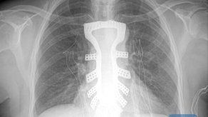 Médicos chinos implantan con éxito un esternón fabricado con impresora 3D