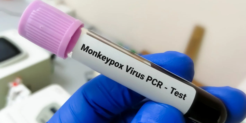 Panamá sin nuevos casos de Viruela del Mono según el MINSA