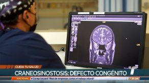 Cuida tu Salud: Craneosinostosis