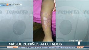 Reportan más de 20 casos de leishmaniasis en Bocas del Toro