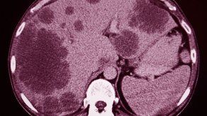 Científicos chinos diseñan nanorobot para estrangular tumores