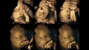 Ultrasonido muestra las consecuencias de fumar durante el embarazo