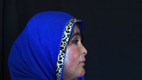 Desfigurada por el ácido