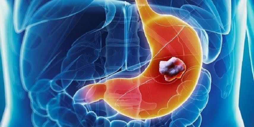 Añadir un nuevo fármaco mejora los resultados de pacientes de cáncer gástrico