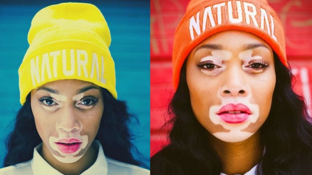 Winnie Harlow La Primera Modelo Con Vitíligo