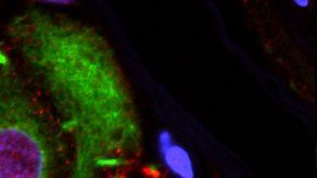 Estudio: Posible vínculo entre apéndice y mal de Parkinson