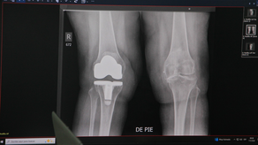 Hospital Santo Tomás inicia jornada gratuita de reemplazo de rodilla