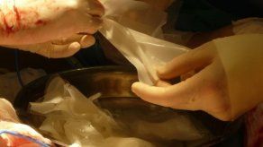 Realizan primer trasplante a mujer quemada