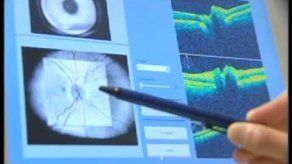 Exploración del nervio óptico podría ayudar contra Alzheimer