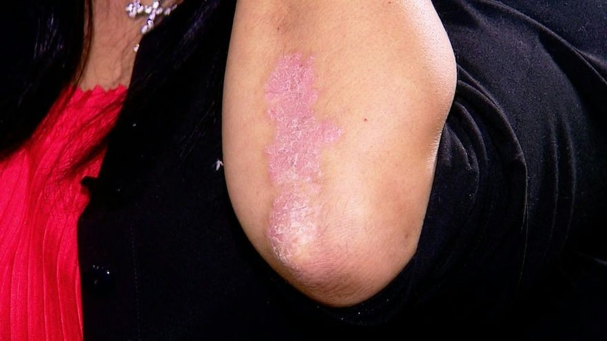 Minsa advierte que la psoriasis puede afectar la piel