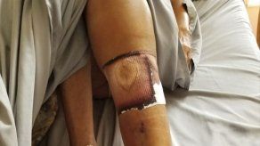 Bacteria carnívora causa la muerte de una mujer en Florida