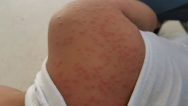El Minsa pide a panameños no automedicarse en casos de alergias por pelusa de polilla