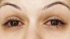 Minsa contabiliza 60 mil 375 casos acumulados de conjuntivitis