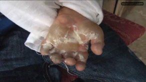 Padrastro le quema las manos a niño de 7 años en Arraiján