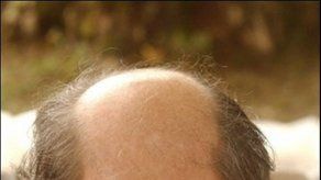 Nuevas vías para tratamiento de calvicie