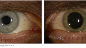 Detectan ébola en el ojo de un paciente curado