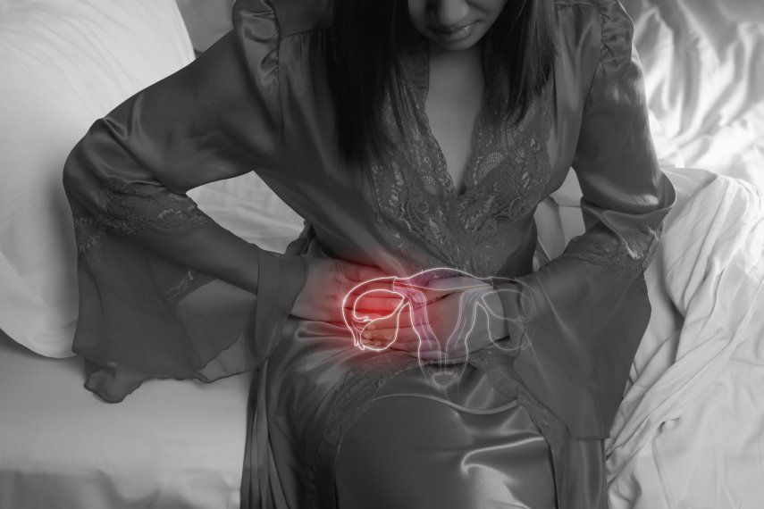La endometriosis está causada por una migración de las células del endometrio