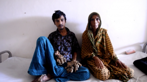 El hombre-árbol bangladesí pide ser amputado