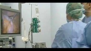 Diabetes tipo 2 se controlaría por intermedio de una cirugía