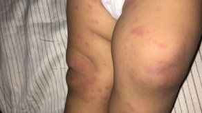 El Minsa pide a panameños no automedicarse en casos de alergias por pelusa de polilla