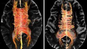 Obesidad aumenta riesgo de mal de Alzheimer y demencia