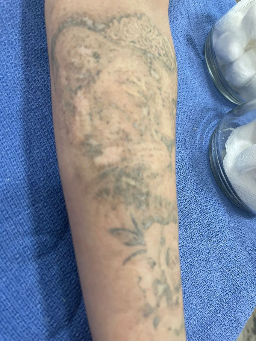Paciente acudió a removerse un tatuaje con láser y resultó con quemaduras