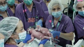 Médicos israelís logran separar a gemelas de 1 año unidas por la cabeza