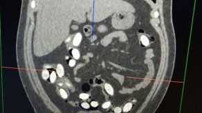 Capturan a joven brasileño con 100 cápsulas con cocaína en su estómago