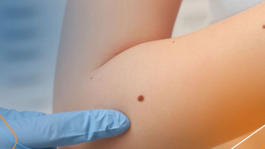 Jornada de revisión de lunares en el Parque Omar