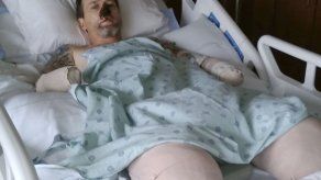 Hombre sufre amputación de extremidades por lamida de perro