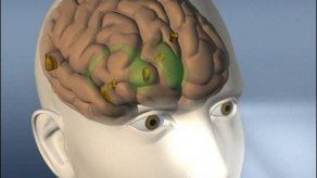 Muere paciente amnésico que ayudó a conocer el cerebro