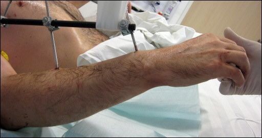 Hombre intenta amputarse su propio brazo