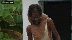 Gigante tumor no le permite al señor Telly vivir en paz