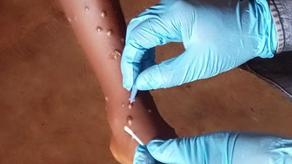 La OMS expresa que la aprobación de este test es de uso de emergencia para los países que enfrentan brotes de mpox.