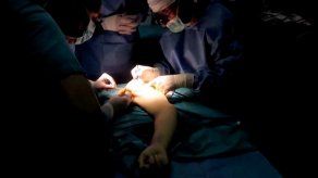 Cirujanos españoles realizan con éxito un trasplante de brazos